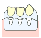 歯ぐきの治療法8