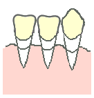 歯ぐきの治療法6
