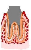 虫歯の治療法5
