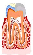 虫歯の治療法3