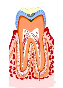 虫歯の進行2