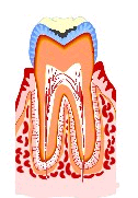 虫歯の進行1