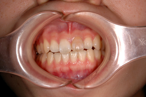 前歯の審美性の症例１Ａ