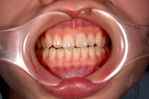 前歯の審美性の症例１Ｂ