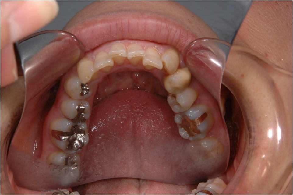 奥歯の審美性回復症例Ａ