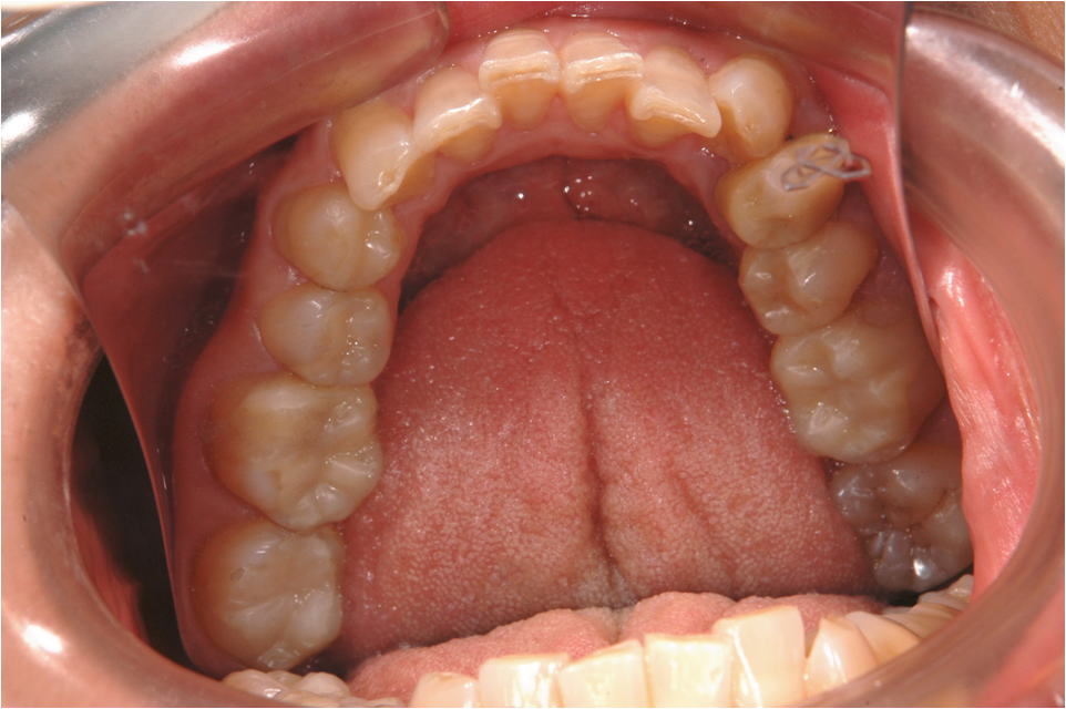 奥歯の審美性回復症例Ｂ