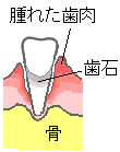 歯ぐき1