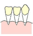 歯ぐきの治療法7