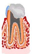 虫歯の治療法4