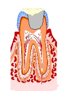 虫歯の進行4
